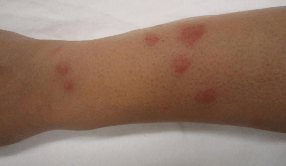 People are different, so are the effects of the bite from one individual to another. However, most bedbug bites are evident as a raised itchy bump that has a burning sensation. In addition, they cause irritation and discomfort.